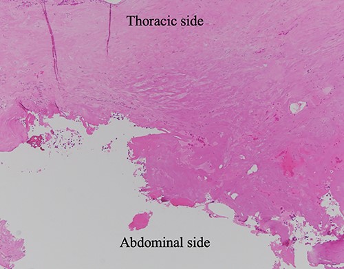 HE-stained image of the specimen with additional diaphragm excision, and the lower side of the photo shows the exfoliated surface of the diaphragm, which turned red due to tissue cauterization; no residual hemangioma structure was found.
