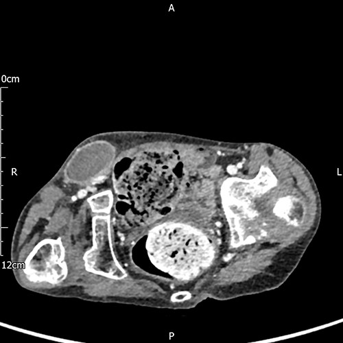 A subcutaneous encapsulated soft tissue mass was described in the right groin raising the suspicion of neoplasia, nodal enlargement or hematoma (axial view).