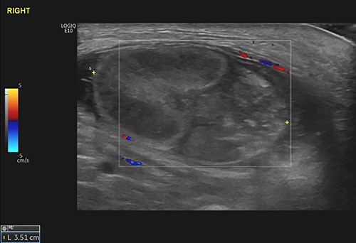 The right testicle was recognized as a 27 × 37 mm heterogeneous mass in the right groin, demonstrating no blood flow. The epididymis was also found bulky. The findings were consistent with the clinical diagnosis of TT in the background of UT.