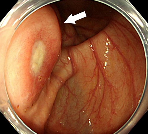 Colonoscopy examination showing an extrinsic compression with ulceration located at the cecum (arrow).