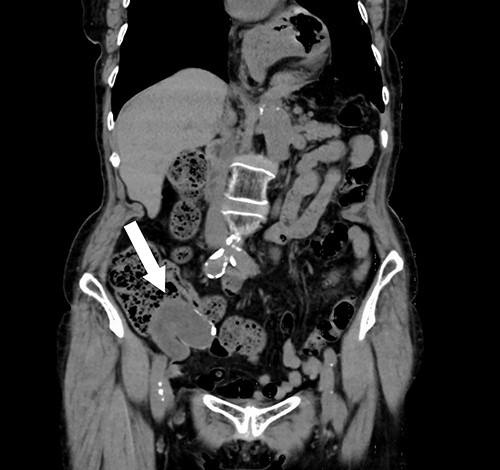Abdominal CT showing a cystic lesion with some calcification in the right iliac fossa (arrow).