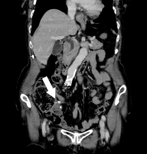 Contrast-enhanced CT showing the enhanced and distorted lesion with focal calcification (arrow).