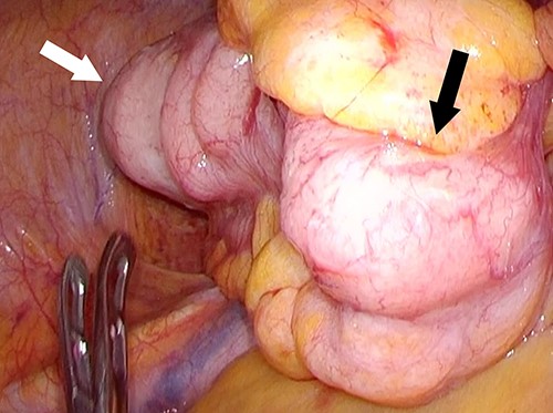Screen capture of the appendiceal tumor during the surgical laparoscopic procedure (white arrow: cecum, black arrow: distended appendix).