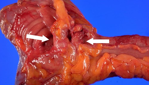 Gross examination of the surgical specimen showing the presence of a partial duplicated appendix, both appendices (white arrows) sharing a 1.5-cm dilated base in a ‘Y-shaped’ pattern on a single caecum.