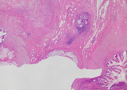 Histopathological examination (H&E stain; ×40 magnification) showing that mucin-producing columnar glandular epithelium with low-grade dysplasia replaced the normal appendiceal epithelium from the common base to both of duplicated appendices.