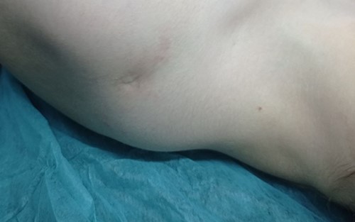 The dermoid cyst on physical examination.