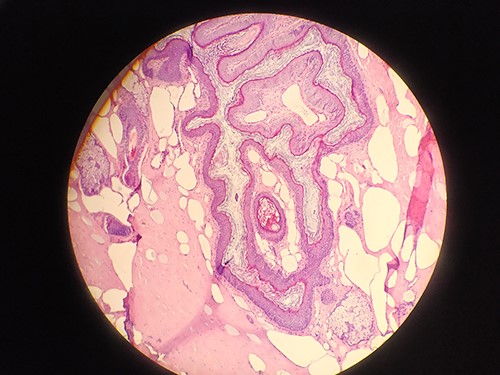 Biopsy confirms the diagnosis of dermoid cyst.