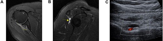Axial (A) and sagittal (B) views of the preoperative MRI demonstrating a full-thickness tear at the level of the myotendinous junction with a fluid-filled gap (yellow arrow) and distal infraspinatus tendon stump attachment on the greater tuberosity. Ultrasound demonstrating a large, well-circumscribed hypoechoic lesion ultimately diagnosed as a venous varix adjacent to the suprascapular artery (C).