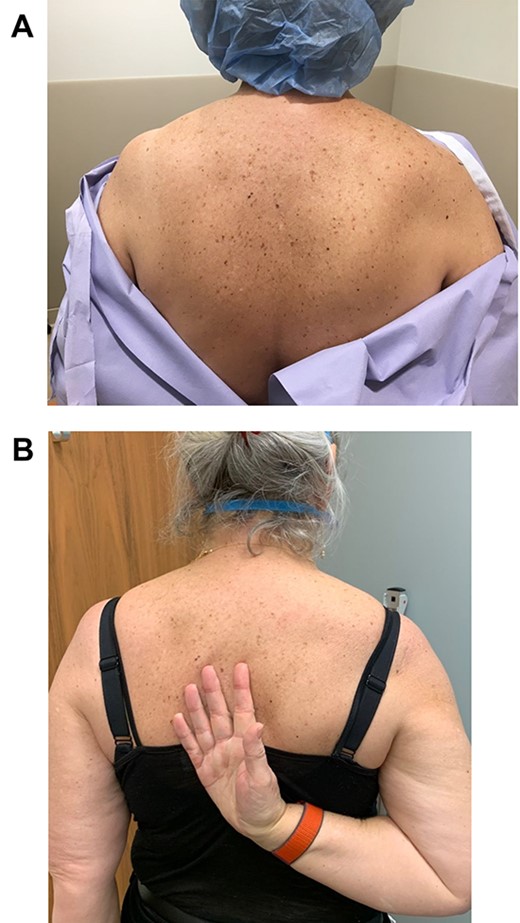 Preoperative (A) and postoperative (B) clinical photograph of the patient’s posterior right shoulder at the 5-year follow-up visit.
