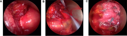 The infraspinatus tear at the myotendinous junction was identified arthroscopically (A) and tagged with a suture to ease identification during open repair (B). Following muscle to tendon repair across the tear in a Mason–Allen configuration, the repair was reinforced with a dermal allograft patch incorporated over the tear (C).