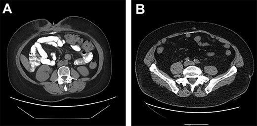 (A) DC misinterpreted as extra luminal contrast consistent with a fistula. (B) DC distributed horizontally along the hernia graft in a patient where CSAB were used.