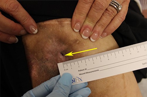 Patient’s right ischial PU on initial encounter. PU has a 4×4 cm, circular scar region surrounding the sinus tract (arrow).