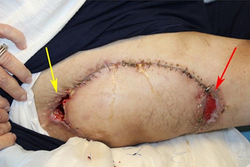 Wound dehiscence after correction of prior wound dehiscence. Sinus tract (yellow arrow) and donor site (red arrow) both dehisced.