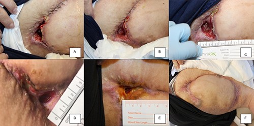 ExoFlo exosome injection course showing progressive improvement in healing. (A) 1 week post-injection; (B) 2 weeks; (C) 3 weeks; (D) 5 weeks; (E) 6 weeks; (F) 8 weeks.