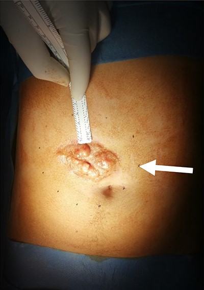 The clinical observation is showing the indurated plaque with multiple protuberant nodules, the limits of the resection are marked out with a 3 cm carcinologic margins (white arrow)
