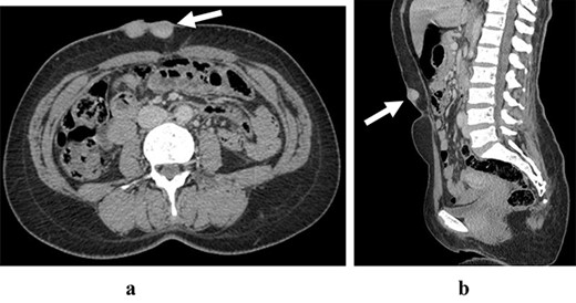 The abdominal CT scan in axial section (a) and sagittal section (b) are showing an heterogeneous enhanced lesion of the anterior abdominal wall respecting aponeurotic facia
