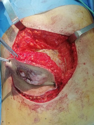 The per-operative view showing WLE of the tumor