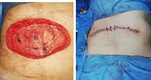 Per-operative view showing the resulting wound defect (a) repaired by primary closure (b)