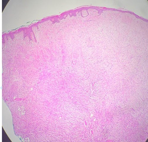 The histological findings are showing dermal proliferation of uniform spindle cells with a storiform pattern, it infiltrates subcutaneous adipose tissue (red circle) (hematoxylin–eosin staining; Original magnification ×40)