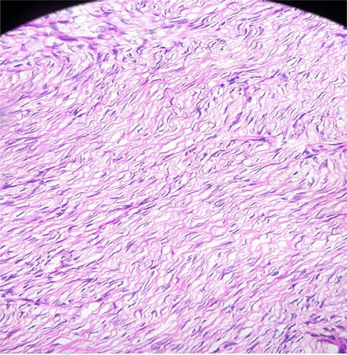 The histological findings showed storiform spindle cells proliferation with minimal atypia (hematoxylin–eosin staining; original magnification ×200)