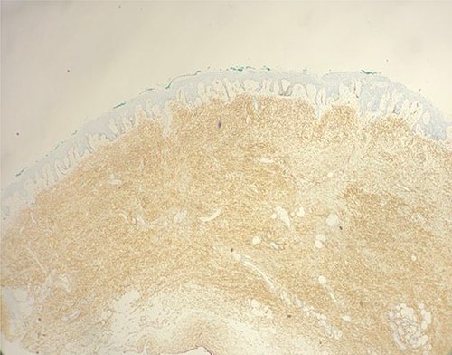 Immunohistochemistry study showing intense and diffuse elements that are positive for CD34 (original magnification ×100).