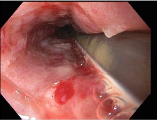 Lower third of esophagus.