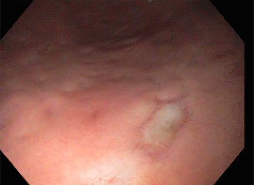 Gastric body.