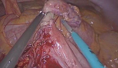 Left-sided caecum as a result of IM with AA.