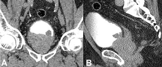 CT urogram of the pelvis. (A) Coronal view; (B) sagittal view.