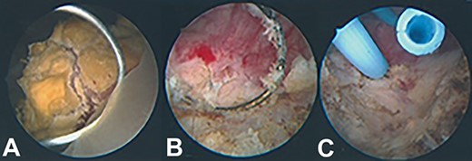 Intraoperative appearance of bladder lesion. (A) Prior to resection; (B) following resection; (C) following ureteric stent insertion.