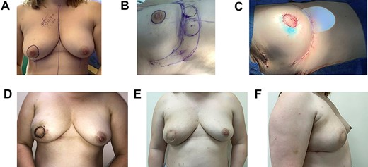 Images showing preoperative marking (A and B), the postoperative outcome on-table (C), at 2 weeks (D) and 6 months after radiotherapy (E and F) in a patient with Paget’s disease of the nipple.