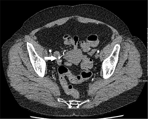 CT mesenteric angiogram showing contrast extravasation in distal ileum.