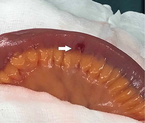 AVM of distal ileum, as indicated by white arrow.