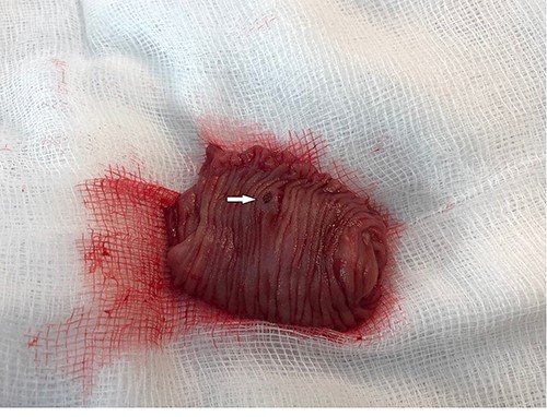 Resected ileal segment showing luminal aspect of AVM, indicated by white arrow.