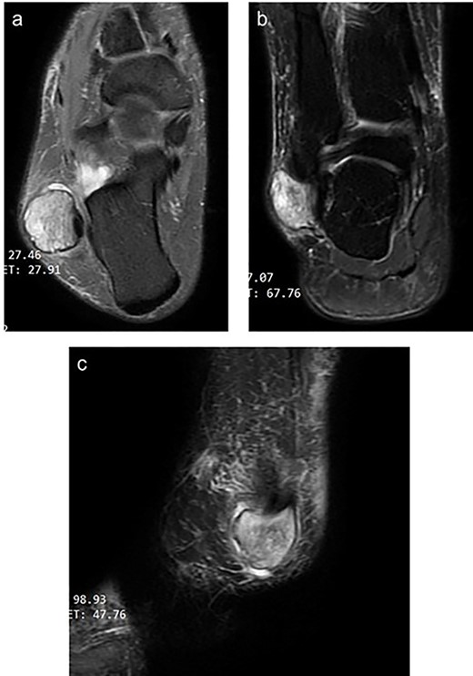 Magnetic resonance image of the right ankle (a: T2-weighted axial view b: T2-weighted coronal view c: fat-saturated T2 weighted sagittal view) showing a thin-walled well-circumscribed lesion within the peroneus longus tendon.