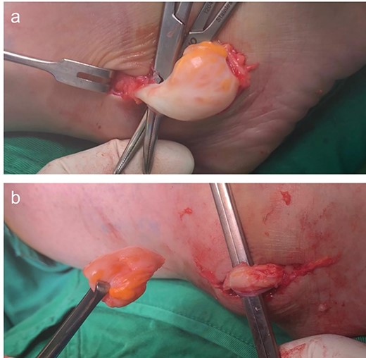 (a) Intra-tendinous ganglion cyst of the peroneus longus. (b) Ganglion cyst dissected free from surrounding tissues showing preserved peroneus longus tendon.