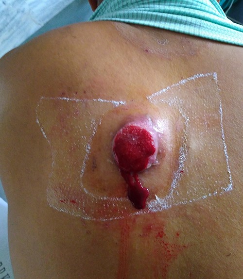 A large ulcero-proliferating lesion in back medial to left scapula near midline.