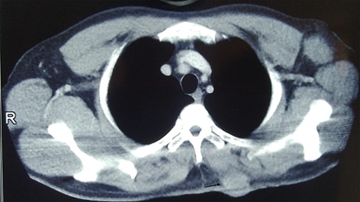 CT image showing well defined lesion in skin and subcutaneous tissue (arrow).
