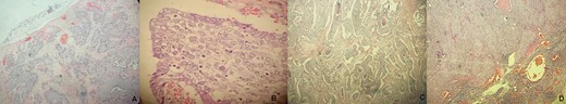 (A) Photomicrograph (H&E, ×10) showing proliferation of tumor cells in lobules, nest, trabeculae and tubules in the dermis. (B) Microscopic examination (H&E, ×20) showing tumor cells with high nucleo-cytoplasmic ratio, round to ovoid nuclei, irregular nuclear membrane and moderate amount of clear vacuolated cytoplasm. (C) Comedonecrosis pattern (H&E, ×10). (D) Microscopic examination showing lymphnode metastasis (H&E, ×10).