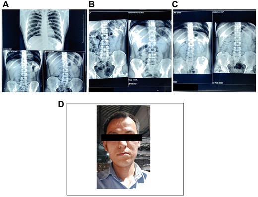 (A) and (B) Showing radiograph abdomen before the treatment. (C) Showing radiograph abdomen after the treatment. (D) Case 1—a 28-year-old male who worked as an engineer at lead battery manufacturing factory at Nalagarh (Himachal Pradesh) for last 6 months.