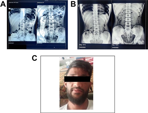 (A) Showing radiograph abdomen before the treatment. (B) Showing radiograph abdomen after the treatment. (C) Case 2—a 24-year-old male who worked as a laborer in a lead battery manufacturing factory in Nalagarh (Himachal Pradesh) for 5 years.