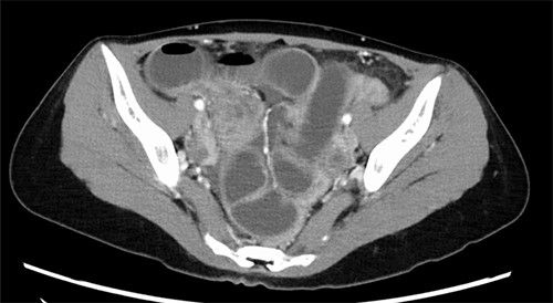Abdomino-pelvic CT image; dilatation of the small bowel with transition point at the terminal ileum.