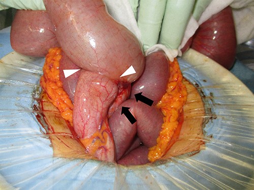 Surgical findings; an appendiceal mass (black arrow) was found and infiltration into the terminal ileum was suspected (white arrowheads).
