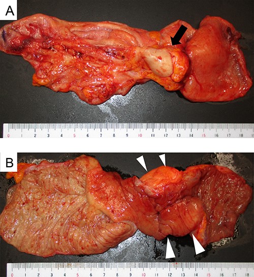 Macroscopic appearance of the ileocecal resected specimen; (A) serosal side; swelling of the appendix and mass lesion at the tip of the appendix (black arrow); (B) mucosal side; thickening of the terminal ileum wall with no occupied lesion in the mucosa (white arrowheads).