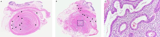 Histopathological findings; (A) the appendix shows wall thickening and luminal stenosis by marked fibrosis; the mucosal layer is compressed and remains at the periphery of this cross section (arrowheads); ectopic endometrial glands scatter in the appendiceal wall and submucosa of the ileum (arrow); haematoxylin and eosin (H&E) stain, ×20; (B) the lumen and mucosa of the appendix are totally absent in this cross section; a large cluster of ectopic endometrial glands and endometrial stroma is seen in the centre of the appendix (square); ectopic endometrial glands are also seen in the muscularis propria (arrowheads) and subserosa (arrow) of the ileum; H&E stain, ×20; (C) a higher magnification image of the square area in (B) shows ectopic endometrial glands surrounded by endometrial stroma; H&E stain, ×200.