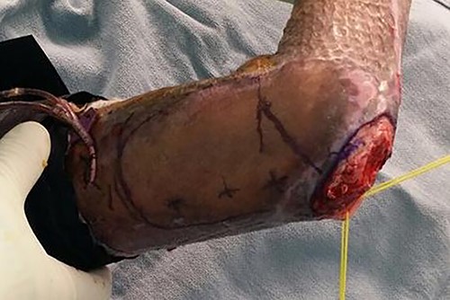 The debrided right elbow wound, with ulnar nerve protected, the proposed flap and axis marked based on unburned skin of the arm.