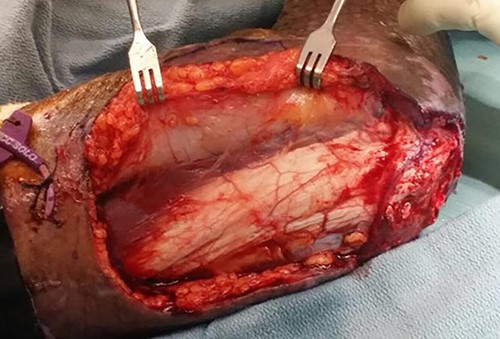 Posterior to anterior elevation towards the intermuscular septum between triceps and brachialis.