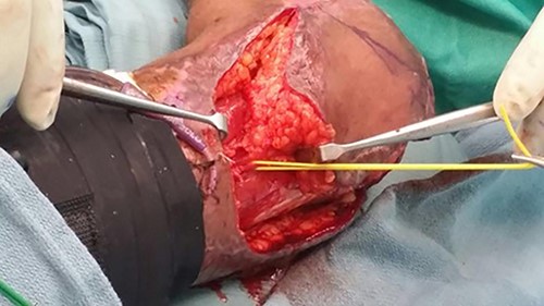 The radial recurrent artery identified and elevated with the flap and the associated fascia.