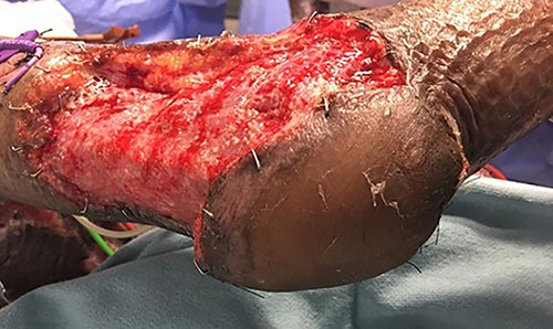 The flap inset and secured without tension, and the donor site covered with a split skin graft.