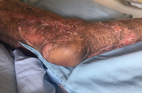 Postoperative outcome at 1 month.